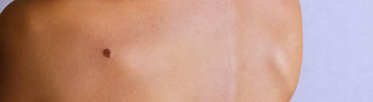 Skin Cancer Removal Bryn Mawr PA