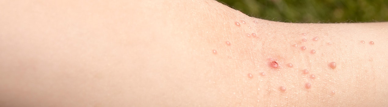 Warts Bryn Mawr PA