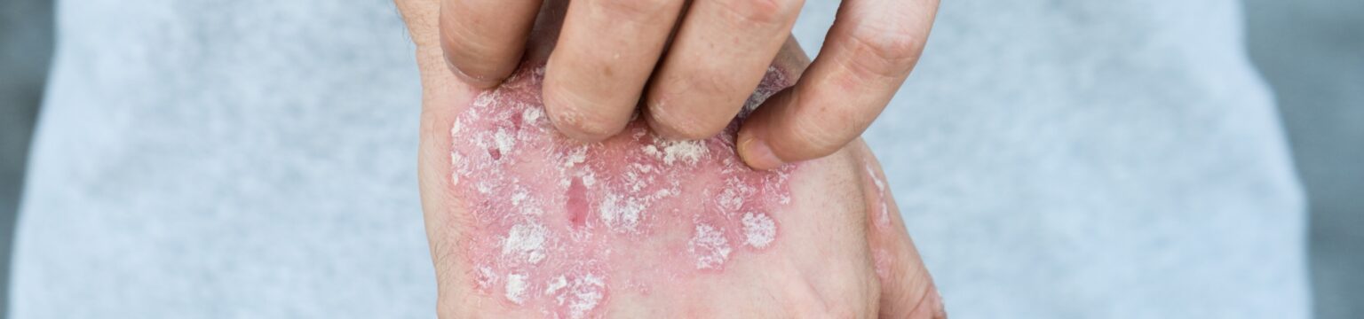 Psoriasis Bryn Mawr PA