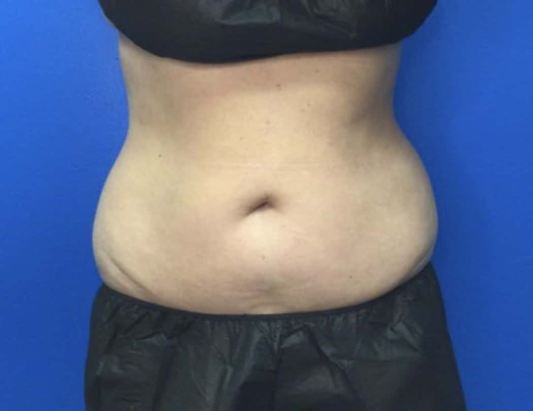 After Image: CoolSculpting - front
