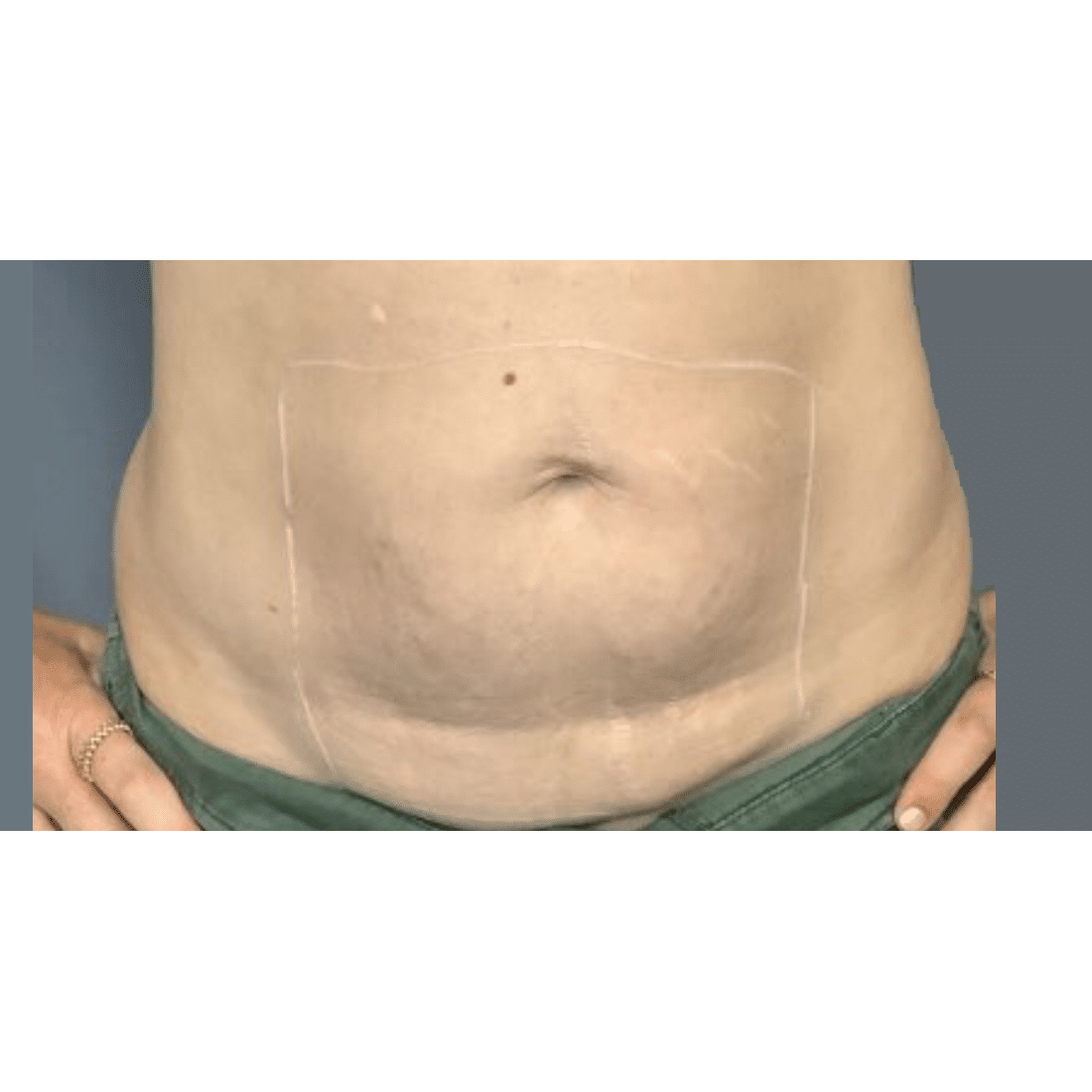 After Image: Morpheus8 - front