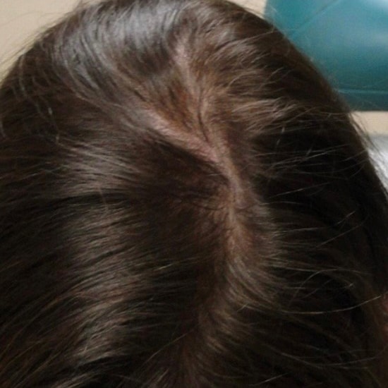 After Image: PRP Hair Restoration - front
