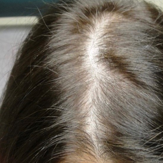 Before Image: PRP Hair Restoration - front