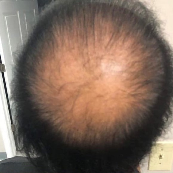 Before Image: PRP Hair Restoration - back