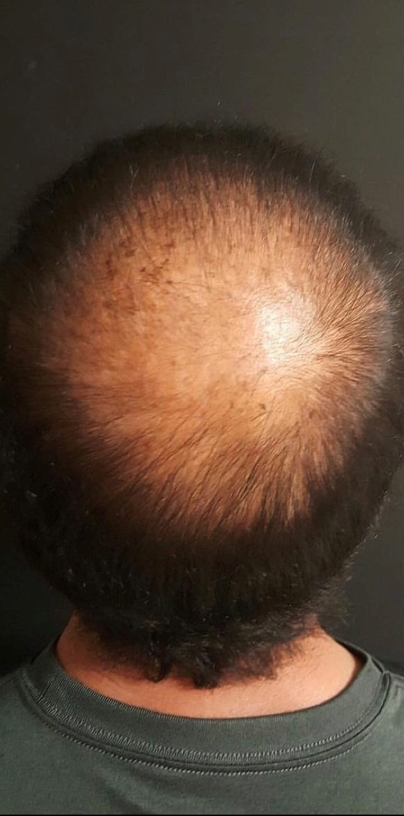 Before Image: PRP Hair Restoration - back
