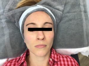 After Image: VI Peel Series
