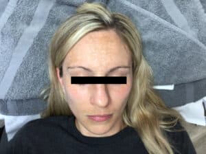 Before Image: VI Peel Series