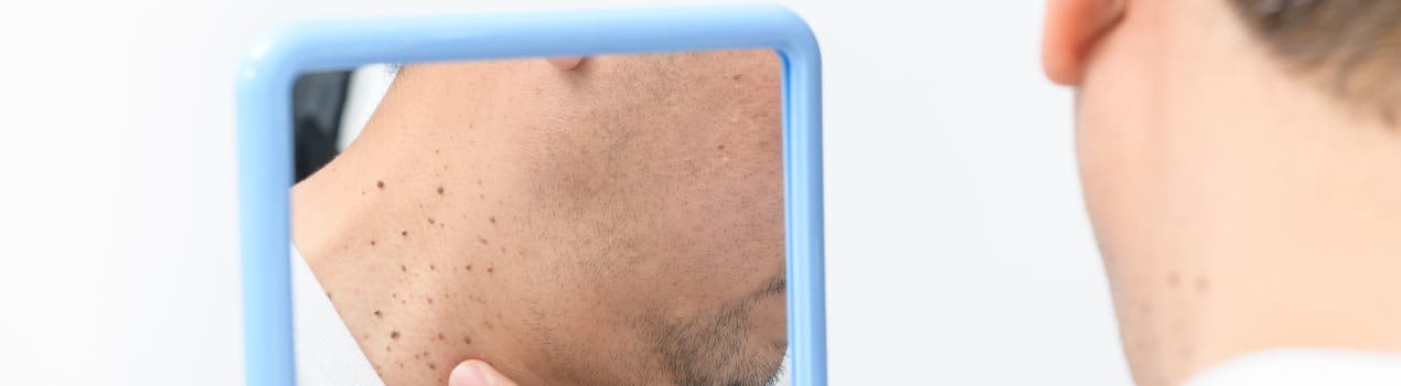 asian middle man looks in the mirror and point to skin tags or acrochordon on neck.