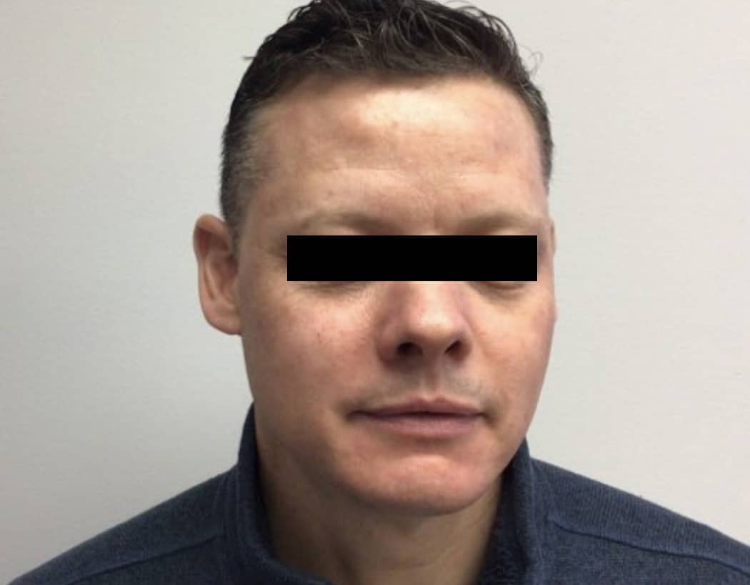 After Image: VI peel B/A - front