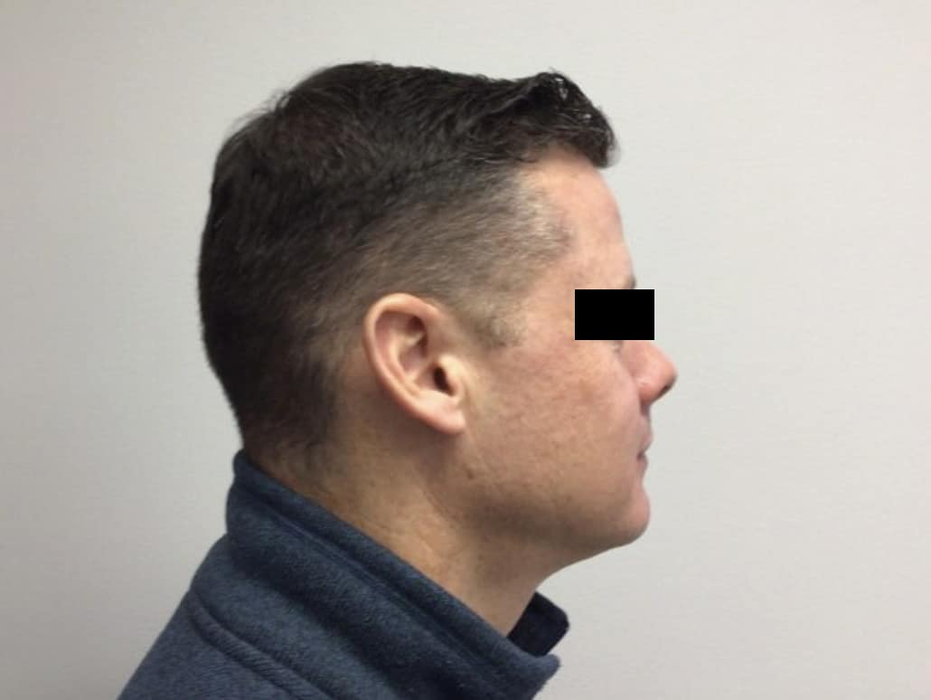 After Image: VI peel B/A - right-side