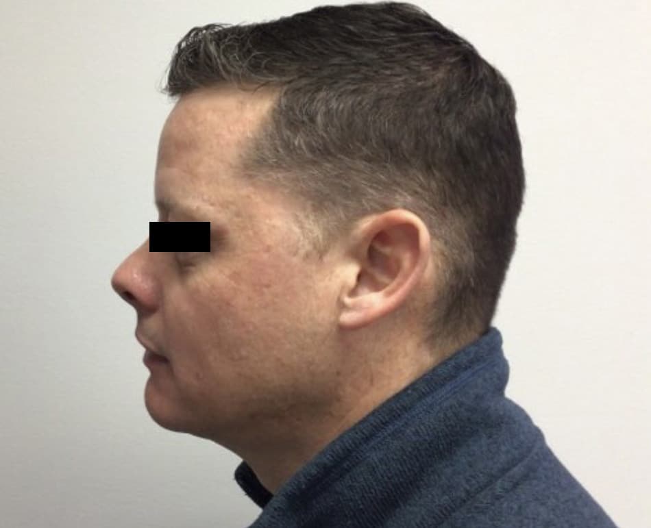 After Image: VI peel B/A - left-side