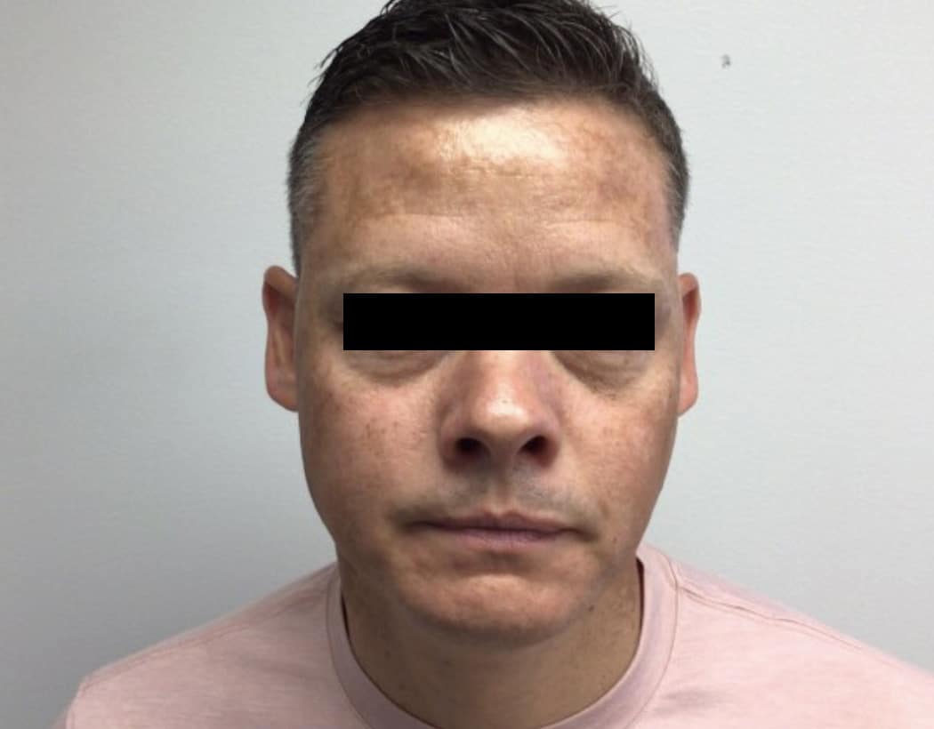 Before Image: VI peel B/A - front