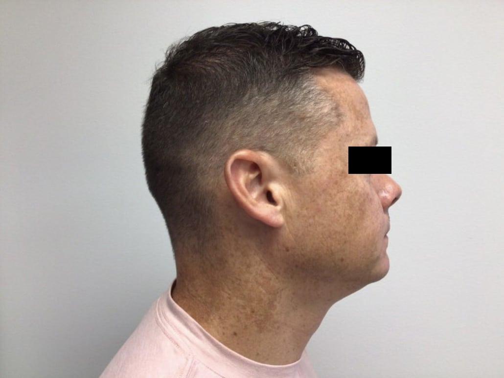 Before Image: VI peel B/A - right-side