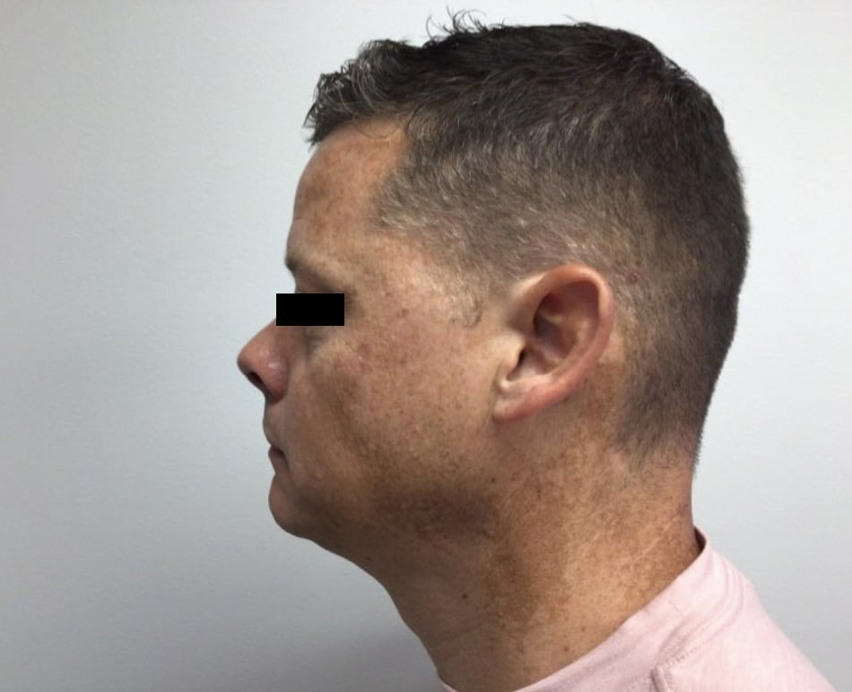 Before Image: VI peel B/A - left-side