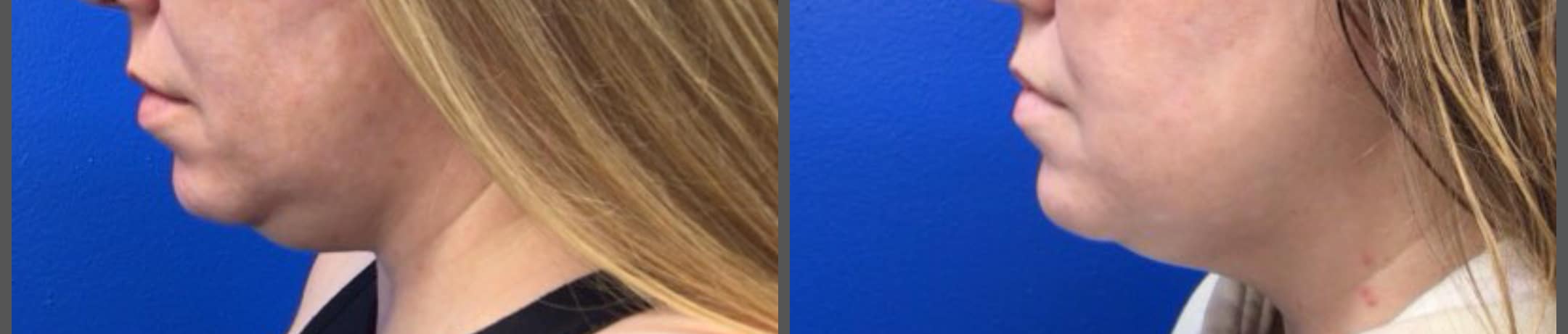 Before and After Image: CoolSculpting Chin - right-side